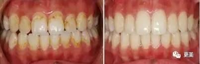 洗牙后牙缝变大松动错位,洗牙后牙齿松动的的亲身经历