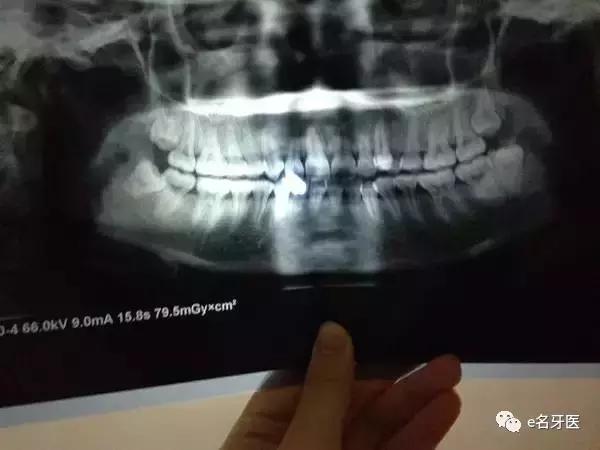 有牙洞并感觉到疼痛了,有牙洞很疼怎么办