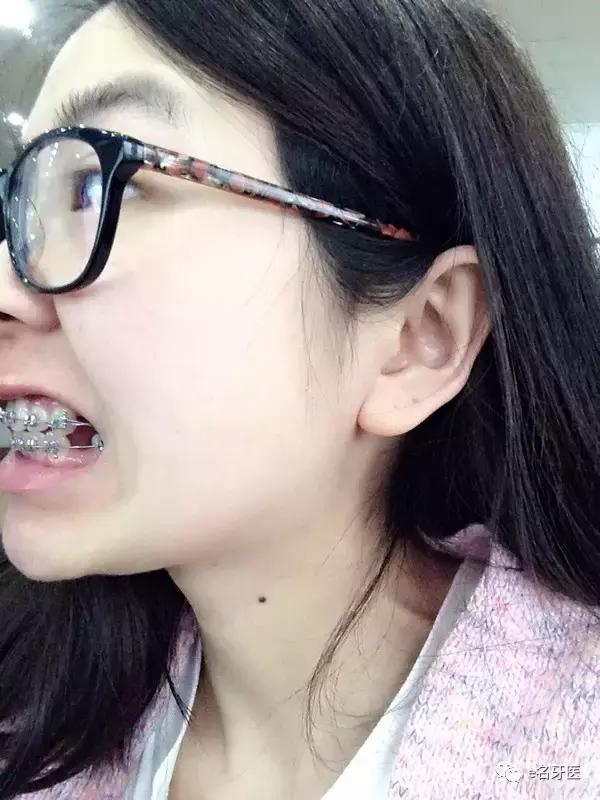 有牙洞并感觉到疼痛了,有牙洞很疼怎么办