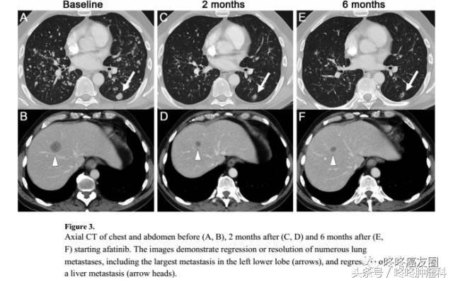 肺腺癌基因种类和相对应的靶向药,肺癌基因没有突变靶向药有效果吗