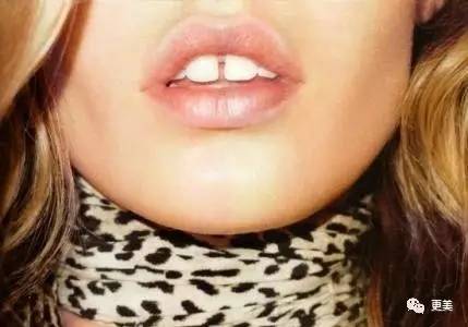 洗牙后牙缝变大松动错位,洗牙后牙齿松动的的亲身经历