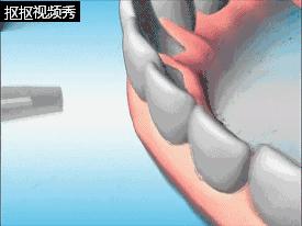 洗牙后牙缝变大松动错位,洗牙后牙齿松动的的亲身经历