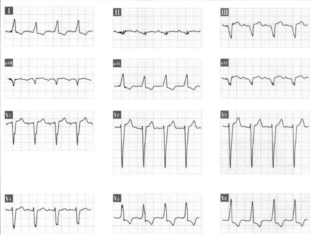 心电图出现异常q波说明心肌缺血,心电图v1v2q波异常严重吗
