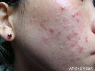 肝火旺的五大症状及调节方法,肝火旺的十大症状怎么调理