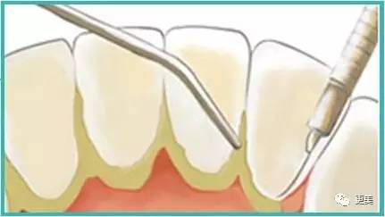 洗牙后牙缝变大松动错位,洗牙后牙齿松动的的亲身经历