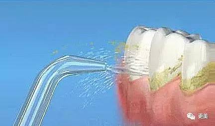 洗牙后牙缝变大松动错位,洗牙后牙齿松动的的亲身经历