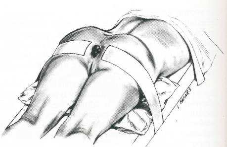 痔疮手术，一种无法言说的痛？