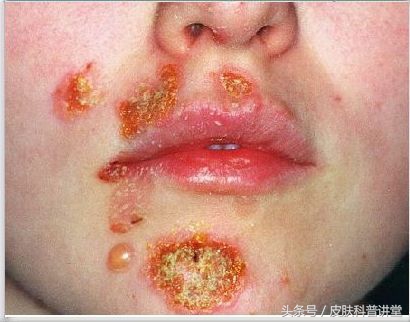 一张图教你辨别脓疱疮,皮肤内脓疱疮最快根除方法