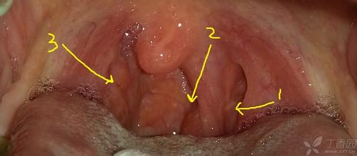 口臭、打鼾、嗓子疼，原来都是这一个原因造成的！