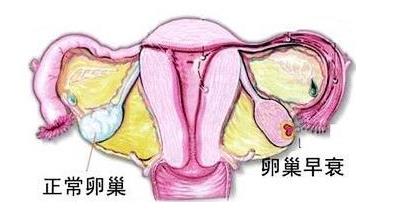 卵巢早衰彩超显示卵巢小怎么调理,子宫卵巢衰老能治吗