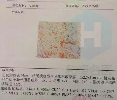 结肠癌转移腹腔中医能治好吗,结肠癌转移肝医生建议不治疗