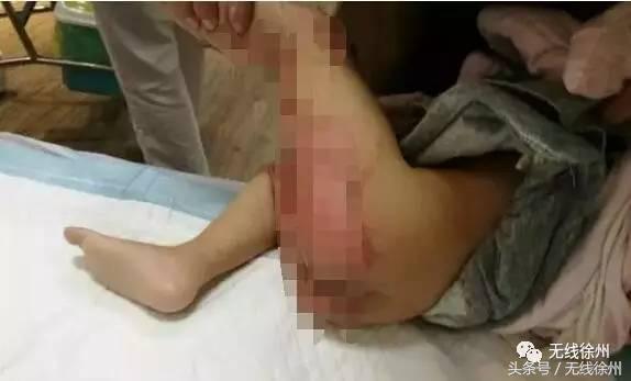 3岁女童被烧成火人！不到半个月徐州一医院已经接了4例！