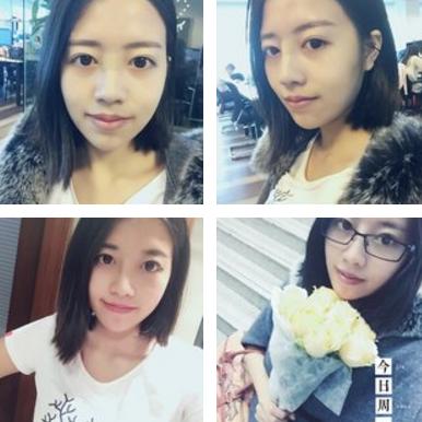 隆鼻后鼻子歪了如何手法矫正,硅胶隆鼻有点歪修复需要再付费吗