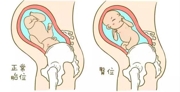 胎位不正散步有利于转正胎位吗,胎位不正医生手动转正胎位