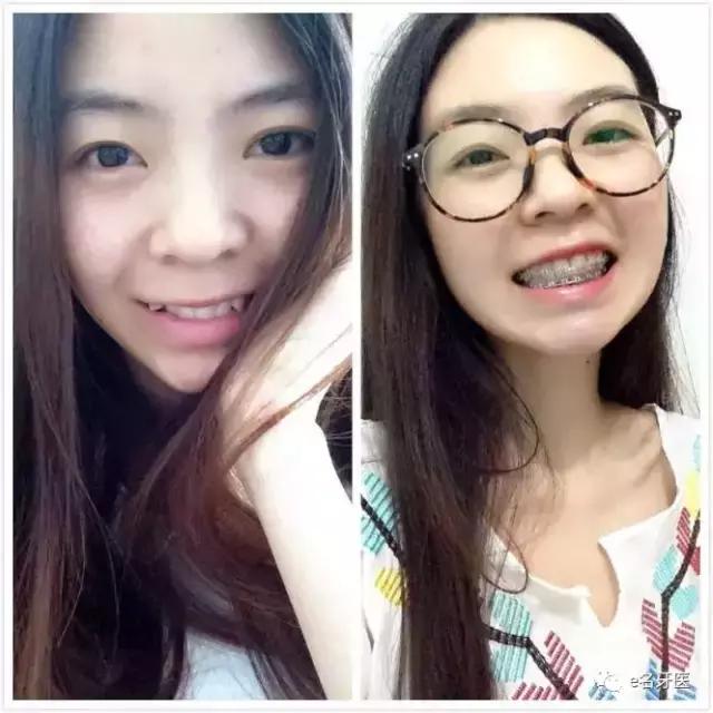 有牙洞并感觉到疼痛了,有牙洞很疼怎么办