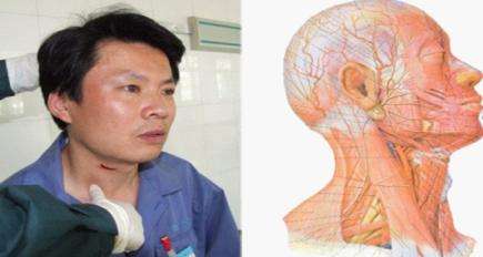 大动脉出血能止住吗,大动脉出血是怎么样