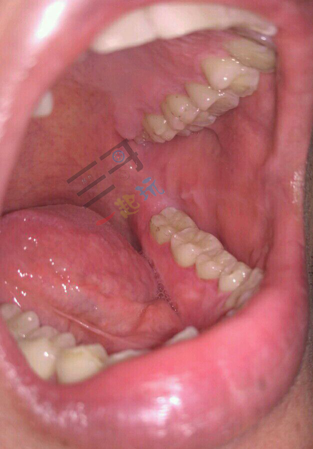亲身体验清洁效果,洗牙体验全视频