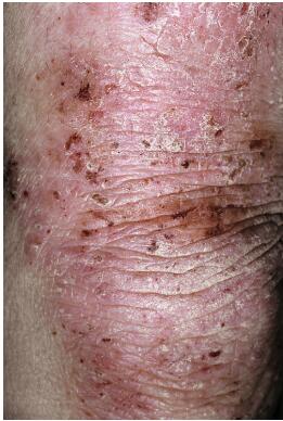 中国湿疹诊疗指南,湿疹中医专家诊疗共识