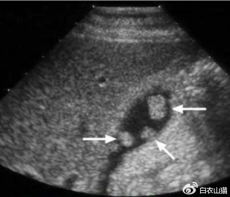 胆囊息肉癌变早期切了还要化疗吗,胆囊息肉加胆结石癌变的几率高吗