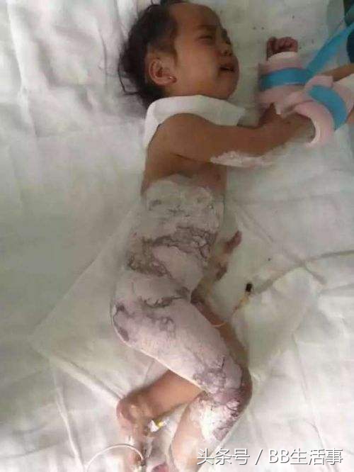 儿童发生烫伤烧伤采取的急救措施,如被烫伤或烧伤急救措施应怎样做