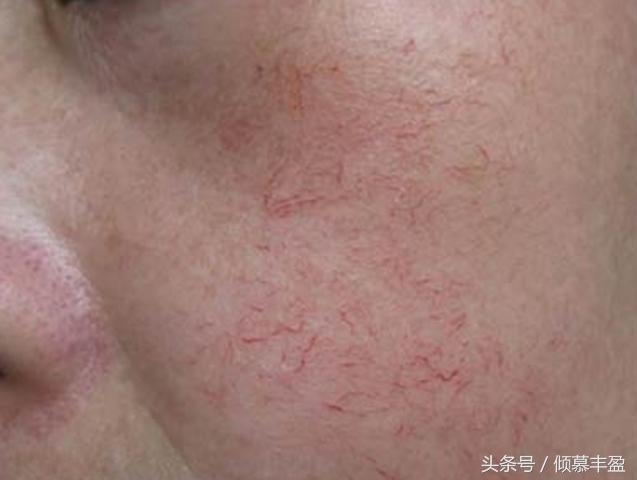 咽部红有血丝是什么原因,常年红血丝是什么原因