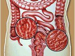 炎症性肠炎不能吃什么,慢性腹泻是肠炎吗