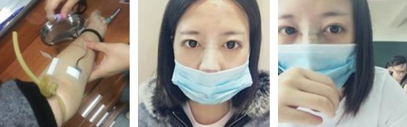 隆鼻后鼻子歪了如何手法矫正,硅胶隆鼻有点歪修复需要再付费吗