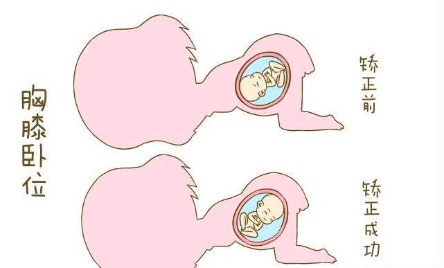 胎位不正散步有利于转正胎位吗,胎位不正医生手动转正胎位