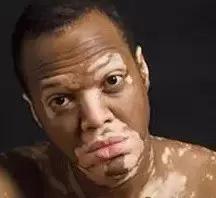 白癜风2021有什么新突破,白癜风最新突破消息