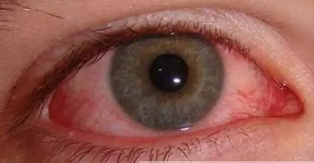 眼睛红过敏是什么原因,眼睛过敏能用红眼兔眼药水吗