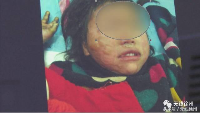 3岁女童被烧成火人！不到半个月徐州一医院已经接了4例！
