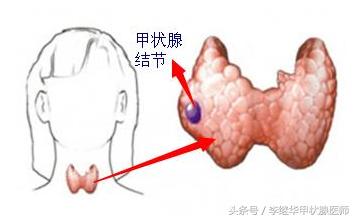 董氏奇穴甲状腺结节针灸视频,甲状腺结节针灸哪些穴位治疗