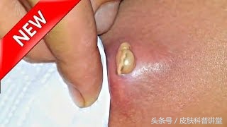 疖病科普文章,疖与疖病