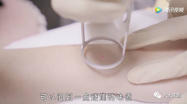 小激光点痣,激光点痣全过程视频