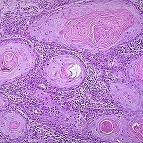 「推荐」读完此文，就会看宫颈癌筛查报告单了