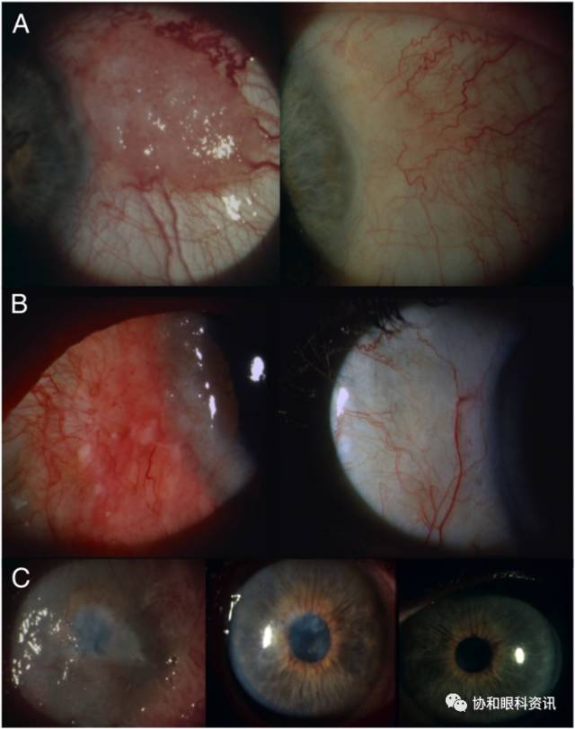 文摘速递丨5-FU单药治疗眼表鳞状细胞肿瘤的长期疗效视察