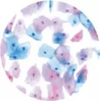 「推荐」读完此文，就会看宫颈癌筛查报告单了