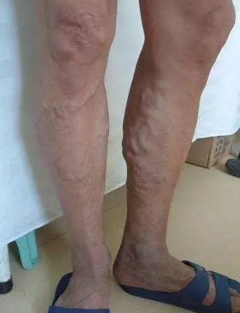 腿上青筋明显的中医辨证,怎样治愈腿上青筋