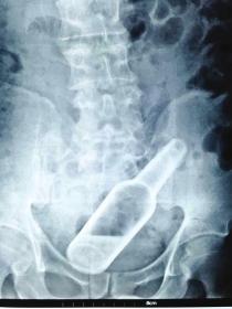 杭州男子肛门被塞20公分长振动棒称年会被恶搞（图