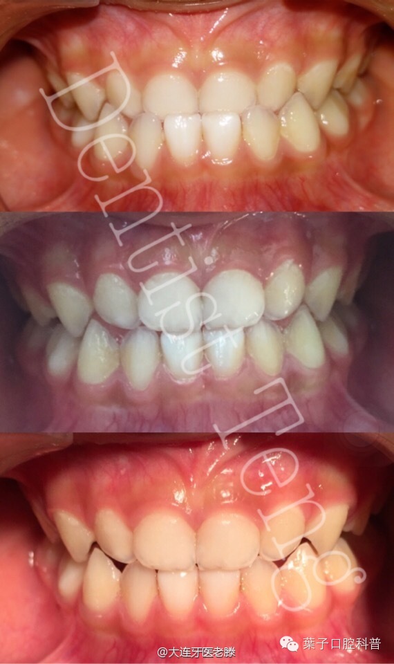 儿童反颌矫正的年龄及步骤,儿童反颌偏颌矫正案例