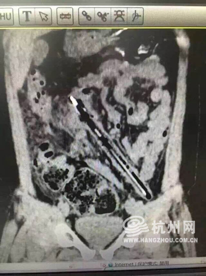 杭州男子肛门被塞20公分长振动棒称年会被恶搞（图