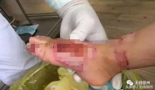 3岁女童被烧成火人！不到半个月徐州一医院已经接了4例！