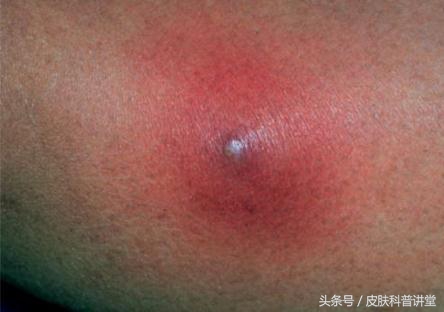 疖病科普文章,疖与疖病