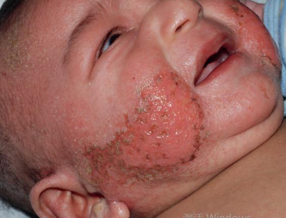 中国湿疹诊疗指南,湿疹中医专家诊疗共识