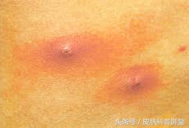 疖病科普文章,疖与疖病