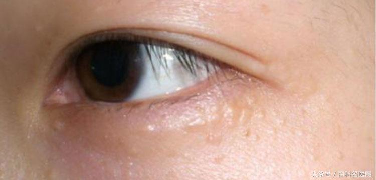 眼霜去脂肪粒哪个眼霜好,眼霜推荐不长油脂粒吗