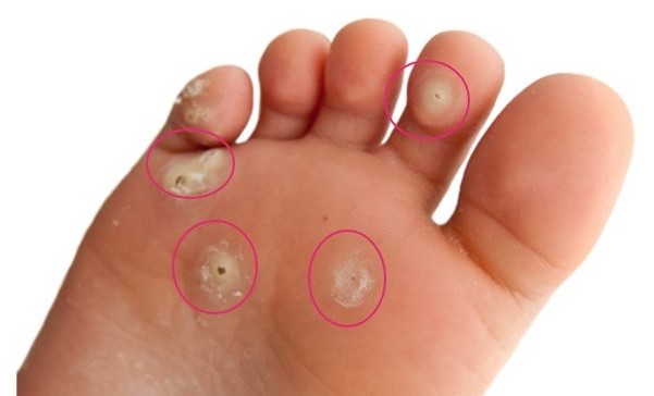 得了鸡眼走路都疼，这7个小秘方收好了，有空试一试！