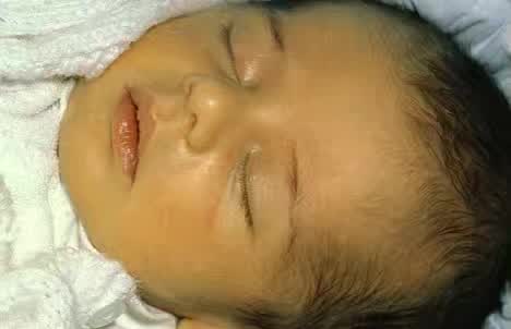 湿疹感染了严重怎么办,湿疹感染的最佳治疗方法婴儿