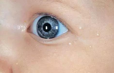 湿疹感染了严重怎么办,湿疹感染的最佳治疗方法婴儿