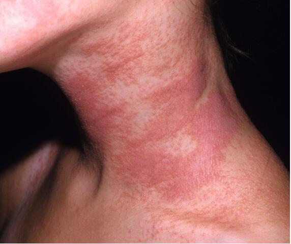 中国湿疹诊疗指南,湿疹中医专家诊疗共识